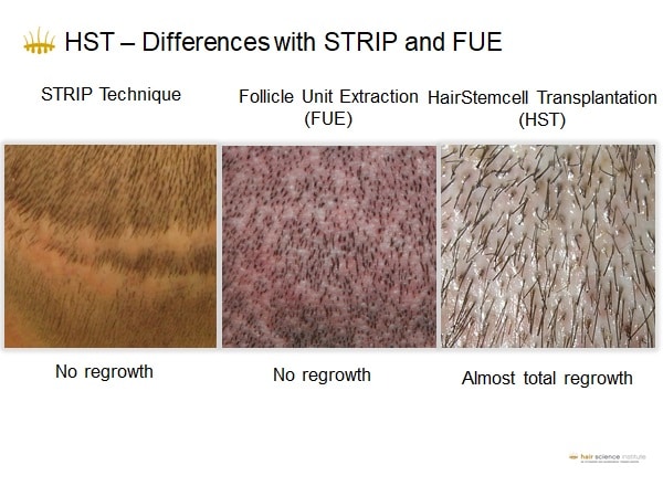 Hair Transplant: Disappointment and Why – Hasci Swiss