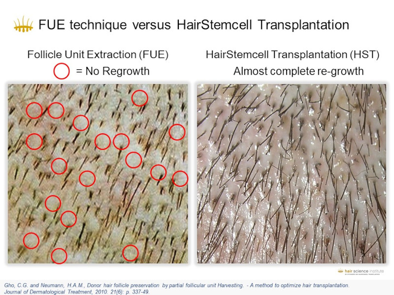 Scarless Hair Transplant: Is It Really Possible? The HST/PL‑FUT Advantage
