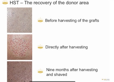 Hair Stem Cell Transplantation HST