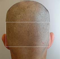 HAIR TRANSPLANT WITHOUT SCARS AND WITHOUT BANDAGE – Hasci Swiss
