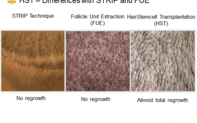 What is the best hair transplant technique?