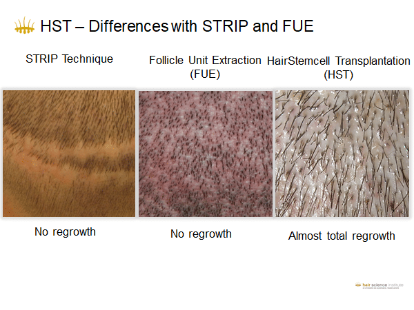 What is the best hair transplant technique?